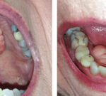 Torus mandibular: el crecimiento de hueso que podría deformar tu boca por bruxismo