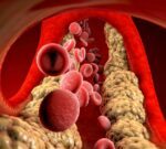 Qué son las estatinas para los triglicéridos altos, ¿qué enfermedades previenen?