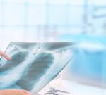 YES1, la proteína que podría combatir el cáncer de pulmón