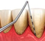 Las personas con periodontitis pueden tener el doble de riesgo de padecer Alzheimer y el triple de sufrir un ictus isquémico