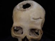 Hallan pruebas de que el primer paciente operado de cáncer vivió hace 4.500 años en el Antiguo Egipto