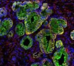 Señalan una proteína antibacteriana como posible diana contra el cáncer de páncreas