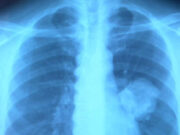 El cáncer de pulmón afecta a la salud sexual del 60 % de los pacientes