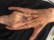 ¿Cómo es una mano humana con SINDACTILIA?