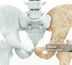 La osteoporosïs podría frenarse, según un estudio de la Universidad de Cantabria (UC)
