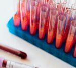 Las personas con este tipo de sangre tienen mayor riesgo de sufrir un derrame cerebral antes de los 60 años