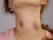 Un chupetón en el cuello podría ser mortal