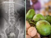 Un hombre fue atendido de gravedad tras introducirse un coco en su ano