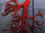 Un hombre con insuficiencia cardíaca tosió un coágulo con forma de rama