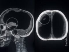 El hombre que vivió casi sin cerebro y nadie lo notó durante 44 años