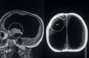 El hombre que vivió casi sin cerebro y nadie lo notó durante 44 años