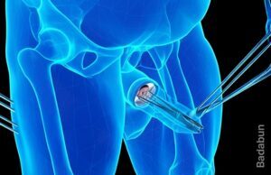 Tres datos de la circuncisión que toda mujer debe saber