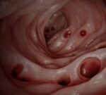 La mayoría de las personas desarrollan diverticulosis en la edad adulta