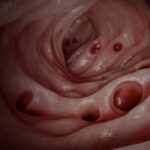 La mayoría de las personas desarrollan diverticulosis en la edad adulta