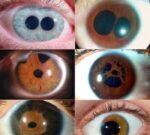 ¿Qué es la policoria y a qué organo del cuerpo afecta?