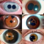 ¿Qué es la policoria y a qué organo del cuerpo afecta?