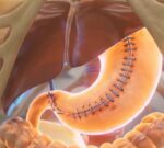 ¿Qué pasa si comes sin parar tras una manga gástrica?