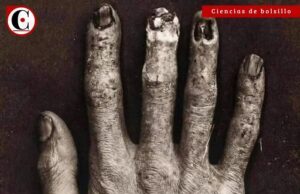 Así se veía la mano de un técnico de Rayos X antes del Siglo XX