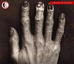 Así se veía la mano de un técnico de Rayos X antes del Siglo XX
